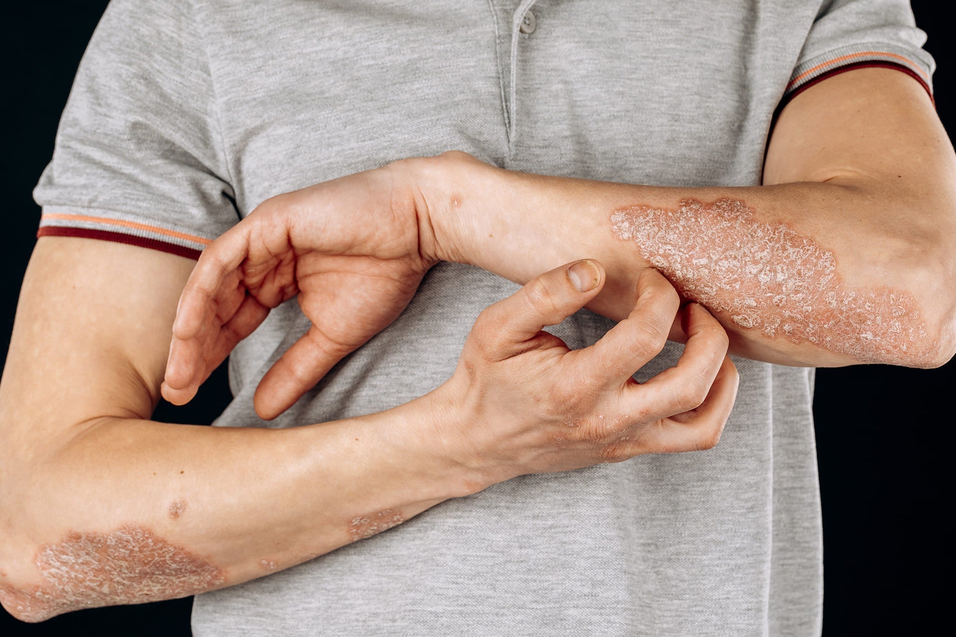 is it eczema or psoriasis understanding the differences